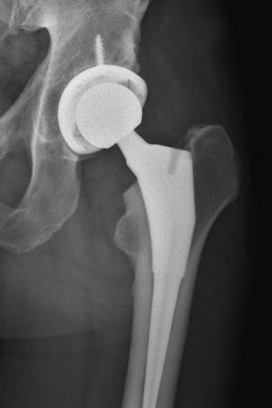 An X-ray image taken after hip replacement surgery